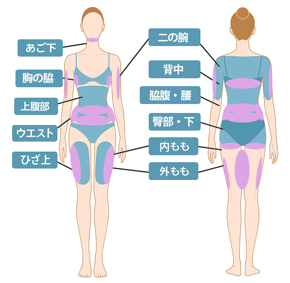 脂肪冷却の適応部位図